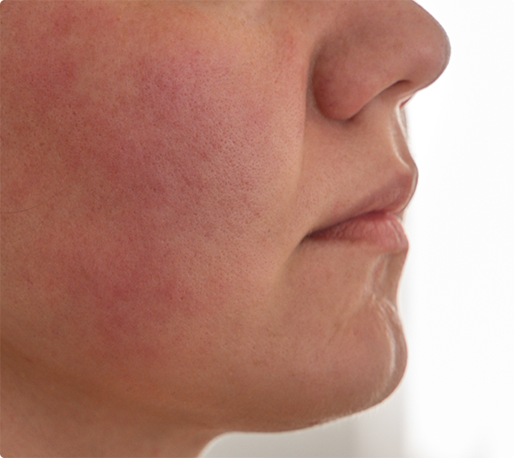 sensitive skin